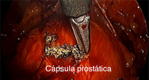 Incisión de cápsula prostática con monopolar.