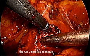 Incisión, apertura de cápsula e identificación de adenoma prostático.