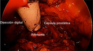 Disección digital entre adenoma prostático y la cápsula.