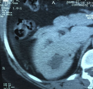 Tumor renal derecho con trombo en vena renal.