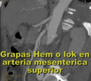 Grapas Hem-o-lok en arteria mesentérica superior y aún hay paso de medio de contraste.