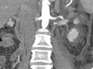 Grapas Hem-o-lok en arteria renal derecha.
