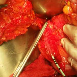 Anastomosis apéndice-uréter.