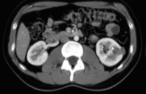 Imagen de la lesión renal en un corte tomográfico en fase contrastada.
