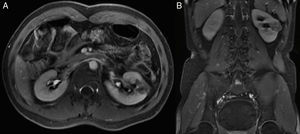 Imagen por resonancia magnética T2. A) Corte axial. B) Corte coronal evidenciando lesión renal izquierda