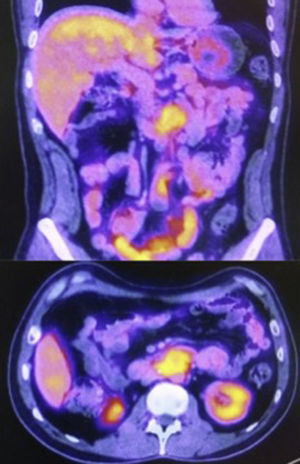 PET-CT muestra tumor retroperitoneal.