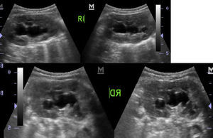 El ultrasonido renal muestra una hidronefrosis bilateral leve.