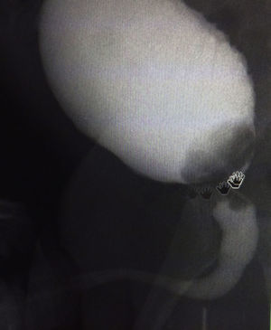 Cistouretrograma que muestra en una proyección lateral un defecto de llenado a nivel del piso vesical con ligera prolongación a uretra prostática.