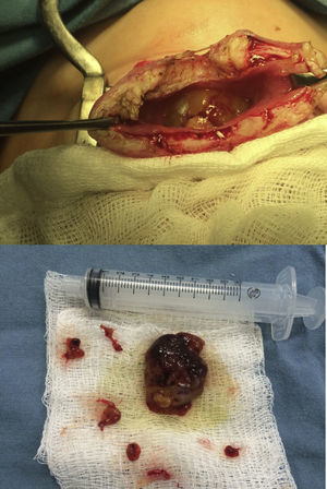 En la exploración quirúrgica se observa un tumor dependiente de cuello vesical exofítico de 8cm, lobulado, de aspecto gelatinoso, con líquido color parduzco en cavidad vesical.