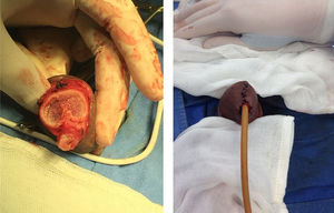 Penectomía parcial. Se observa uretra disecada para posterior realización de meato uretral; cuerpos cavernosos y uretra sin alteraciones macroscópicas.