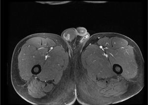 Imagen de resonancia magnética en corte axial en T1 donde se observan áreas hiperintesas que infiltran el testículo derecho.