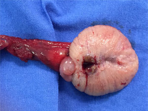 Testículo derecho abierto longitudinalmente posterior a la extirpación de la pieza; no se observa infiltración extensa del parénquima testicular.