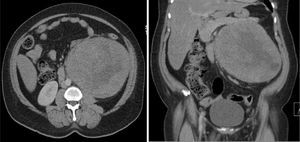 Tomografía contrastada con tumor renal izquierdo.