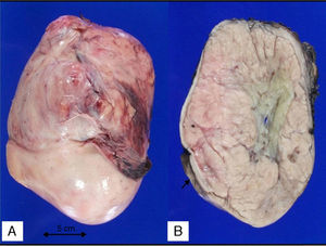 Nefroma mesoblástico. A) Imagen macroscópica. B) Superficie de corte, heterogénea, multinodular, la flecha indica el escaso remanente renal.