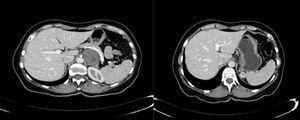Imagen de urotomografía, donde se observa la lesión tumoral en polo superior de riñón izquierdo, y una segunda lesión sólida retroperitoneal adyacente a la glándula suprarrenal izquierda, que desplaza estructuras adyacentes.