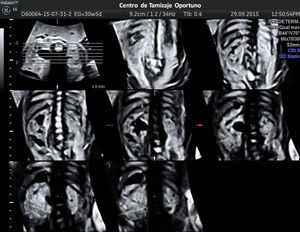Imagen utilizando TUI que permite obtener cortes multiplanares en cortes coronales de 4mm de diámetro. Se observa la gran dilatación del sistema ureteropielocalicial izquierdo. Basado en The Society for Fetal Urology Consensus Statement (2010).
