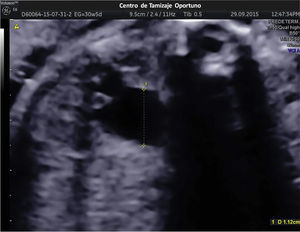 Imagen ultrasonido contrastada por volumen de plano A [VCI-A] en un corte axial a las 30 semanas de gestación muestra dilatación de la pelvis renal izquierda con un diámetro anteroposterior de 11.2 mm (dilatación moderada)