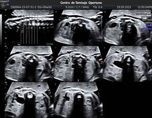 Imagen utilizando TUI que permite obtener cortes multiplanares en cortes axiales de 5mm de diámetro. Se observa la gran dilatación del sistema ureteropielocalicial izquierdo. Basado en The Society for Fetal Urology Consensus Statement (2010).