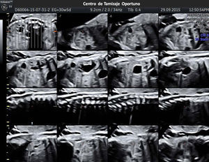 Imagen utilizando TUI. Se observa la gran dilatación del sistema ureteropielocalicial izquierda. Basado en The Society for Fetal Urology Consensus Statement (2010).