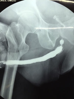 Uretrografía prequirúrgica. Estenosis uretral bulbar proximal y UroLume®.