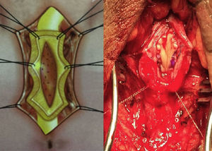 Colocación del injerto de mucosa oral dorsal inlay.