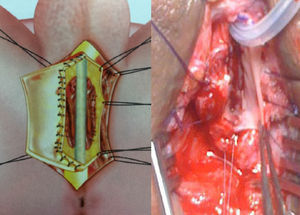 Colocación del injerto de mucosa oral ventral onlay.