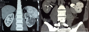Tomografía con reconstrucción urológica muestra tumoración renal izquierda dependiente de cavidades renales, la cual infiltra parénquima renal sin extenderse más allá de la grasa perirrenal.