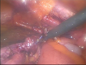 Disección y retracción de uréter en su porción distal.