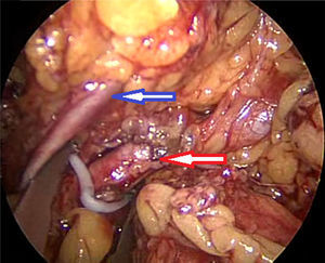 Control vascular del hilio renal. (Arteria renal flecha roja, vena renal flecha azul).