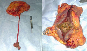 Pieza quirúrgica completa (riñón, uréter y rodete vesical), sección de la pieza quirúrgica la cual muestra tumoración infiltrante de parénquima, la cual macroscópicamente no se extiende a la grasa perirrenal.