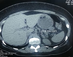 TAC de abdomen que identifica un adenoma de glándula suprarrenal derecha de 22mm.