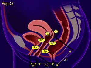 Clasificación POP-Q. Cp: cuerpo perineal; gh: hiato genital; Lvt: longitud total vaginal. Realizado por drawMd App.