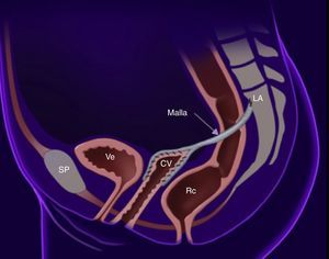 Sacrocolpopexia. CV: cúpula vaginal; LA: ligamento anterior; RC: recto, SP: sínfisis del pubis; Ve: vejiga. Realizado por Draw MD App.
