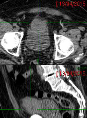 Tomografía computarizada con tumoración en la pared superior de la vejiga hiperdensa, bien delimitada.