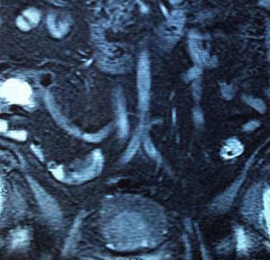 Resonancia magnética con tumoración vesical hiperintensa de aproximadamente 5cm de diámetro.
