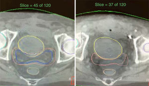 Tomografía axial en simulación (Slice=45/120);tomografía axial verificación (Slice=37/120).