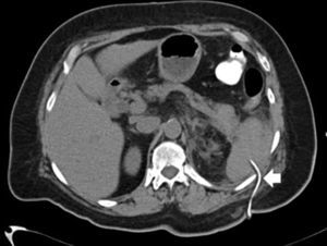 Case 1. Post-PCNL CT scan. Arrow shows the nephrostomy tube traversing the spleen.