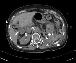 Case 2. Post-PCNL CT scan. The solid arrows show the nephrostomy tube traversing the spleen. The hollow arrows show the free intraperitoneal fluid. The arrowheads show a perinephric hematoma.
