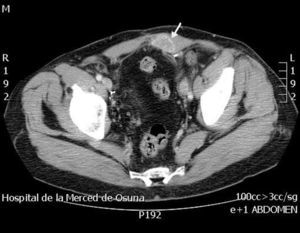 TAC abdominal y pélvica con contraste: se confirma la lesión, bien delimitada, situada en la cara posterior de los rectos abdominales, sin aparente afectación intraperitoneal.