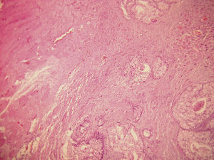Resultado histopatológico idéntico al tumor primario de próstata.