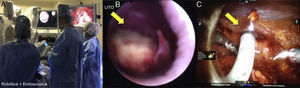 A) Cirugía robótica+endoscópica. B) Localización del lito. C) Cistoscopia transtrocar.