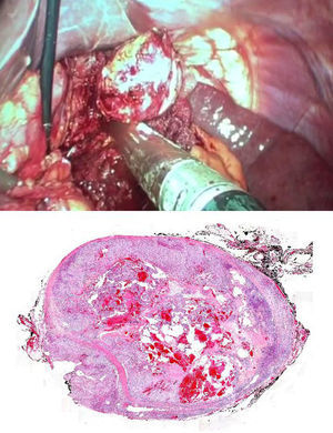 En la imagen superior se aprecia la enucleación completa y sección del pedículo con carga vascular. En la imagen inferior, fotomicrografía de la lesión (con tinción hematoxilina-eosina ×4), en la que se observan abundantes lagunas vasculares repletas de hematíes y áreas de osificación.