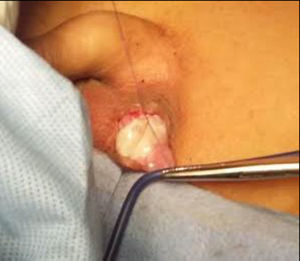 Orquidopexia hacia el dartos con sutura absorbible, fijando testículo a la piel del escroto.