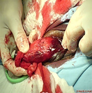 Imagen durante el procedimiento quirúrgico para reparar lesión o fractura de pene.
