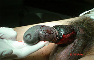 Imagen que muestra una extensa laceración de piel de pene y equimosis extensa.