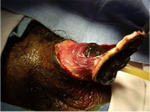 Necrosis de pene en paciente portador de una diabetes mellitus descontrolada.