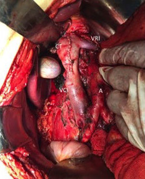 Imagen transoperatoria que muestra cavotomía (CT), vena cava inferior (VCI), vena renal izquierda (VRI) y aorta (A).