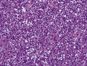 – Inflammatory infiltrate comprised of plasma cells, lymphocytes and some eosinophils (H&E × 200).