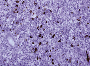 – Immunohistochemical IgG4 staining with increase of IgG4+ plasma cells in the inflammatory infiltrate (× 200).