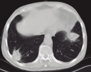– Thoracic CT scan: bilateral pulmonary nodules with air bronchograms and irregular margins.